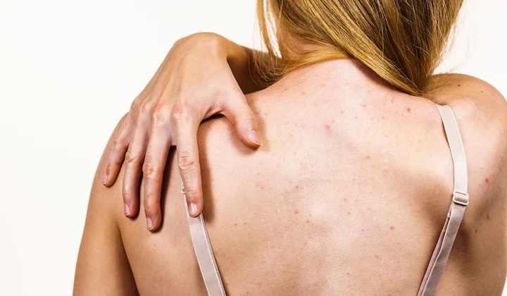 Sonnenallergie Mallorca-Akne was hilft 