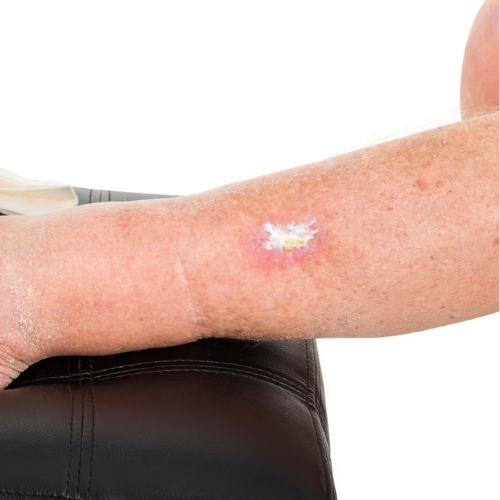 Venenschwäche Stadium 4