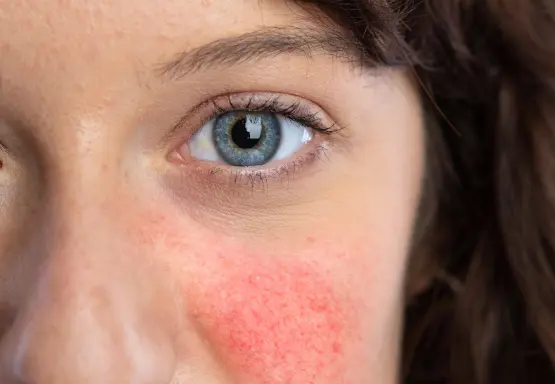 Frau mit und ohne Rosacea im Gesicht