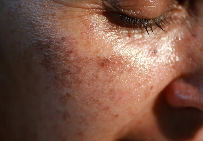 Pigmentflecken & Sonne