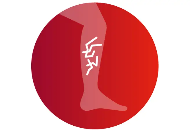 Venenschwäche Symptom Besenreiser