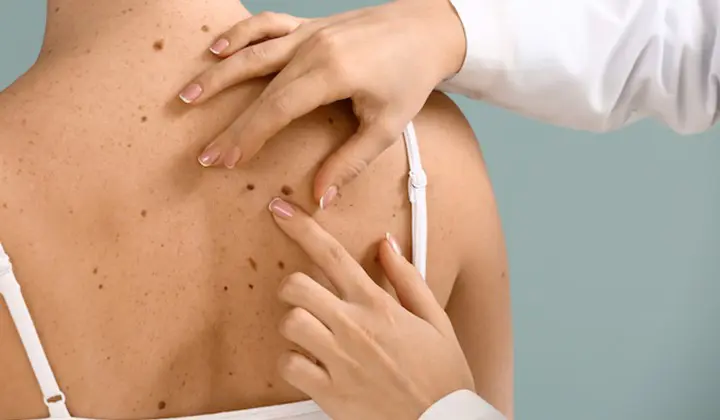 Erhöhtes Hautkrebsrisiko durch Sonne 