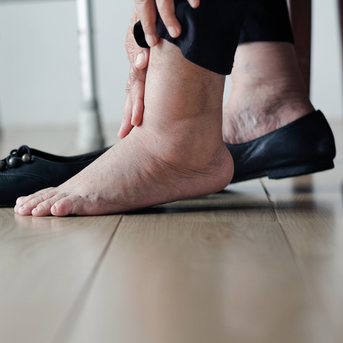 Venenschwäche Stadium 3