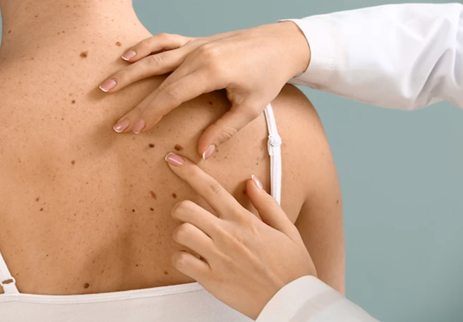 Sonne & Hautkrebsrisiko